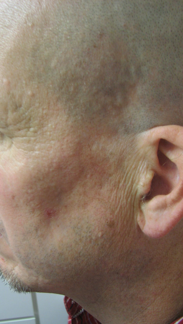 Facial Atrophy Causes: Essential Facts and Answers