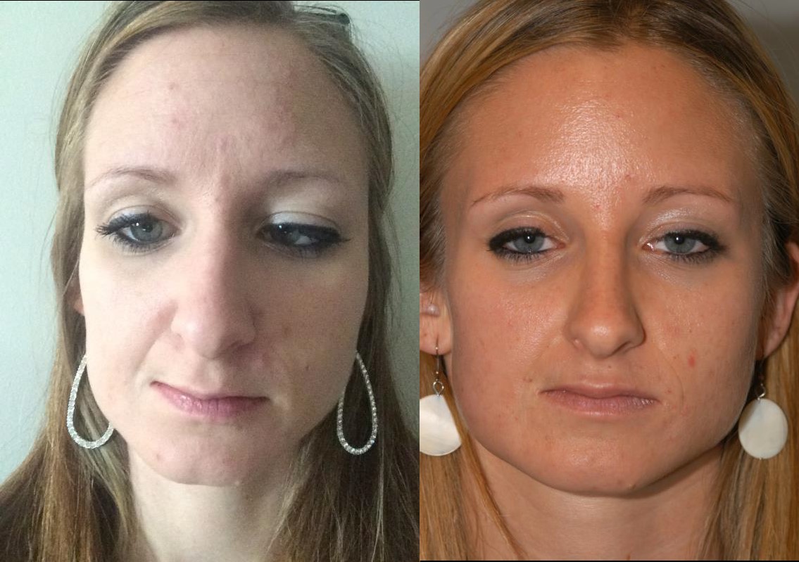 Parry‑Romberg Syndrome in Adults: Essential Guide