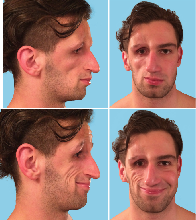 Parry‑Romberg Syndrome Treatment: Options & Expect