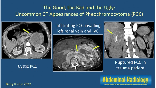 Pheochromocytoma vs Adrenocortical Carcinoma Radiology