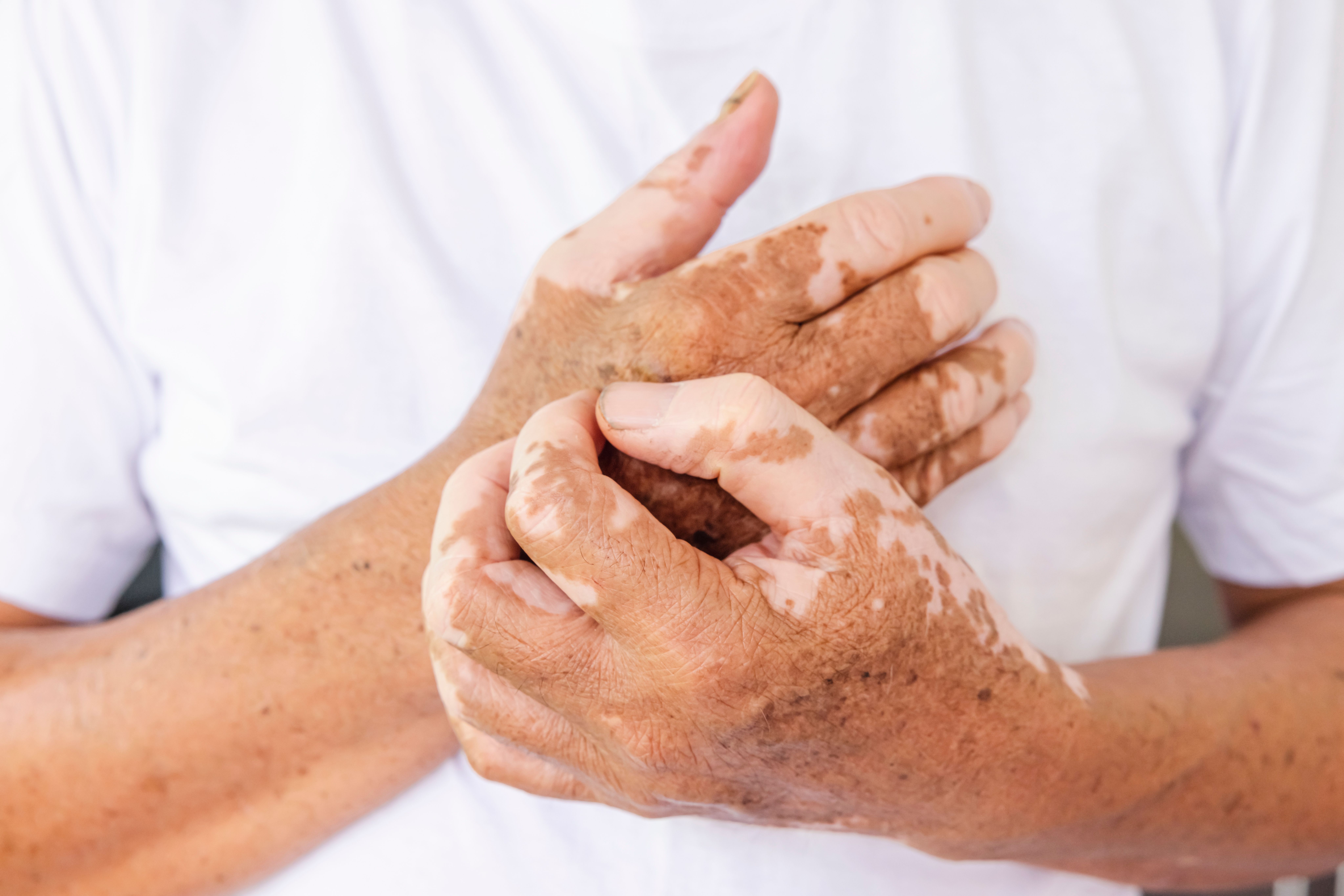 Rheumatoid Arthritis and Vitiligo: Key Links Explained