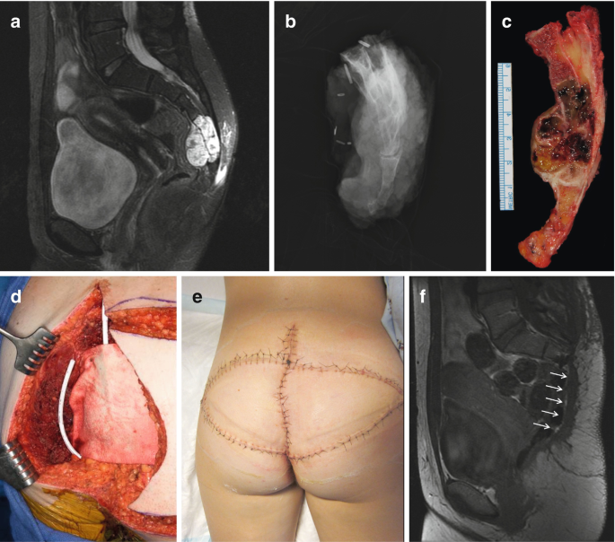 Sacral Chordoma Treatment: What Works, Risks & Recovery