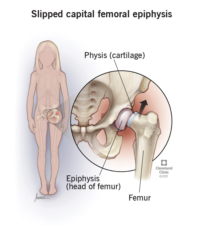 SCFE Causes: What Triggers a Slipped Hip (Femoral)?