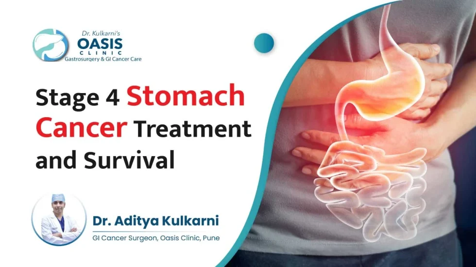 Stage 4 Stomach Cancer Survival Rate: Quick Facts