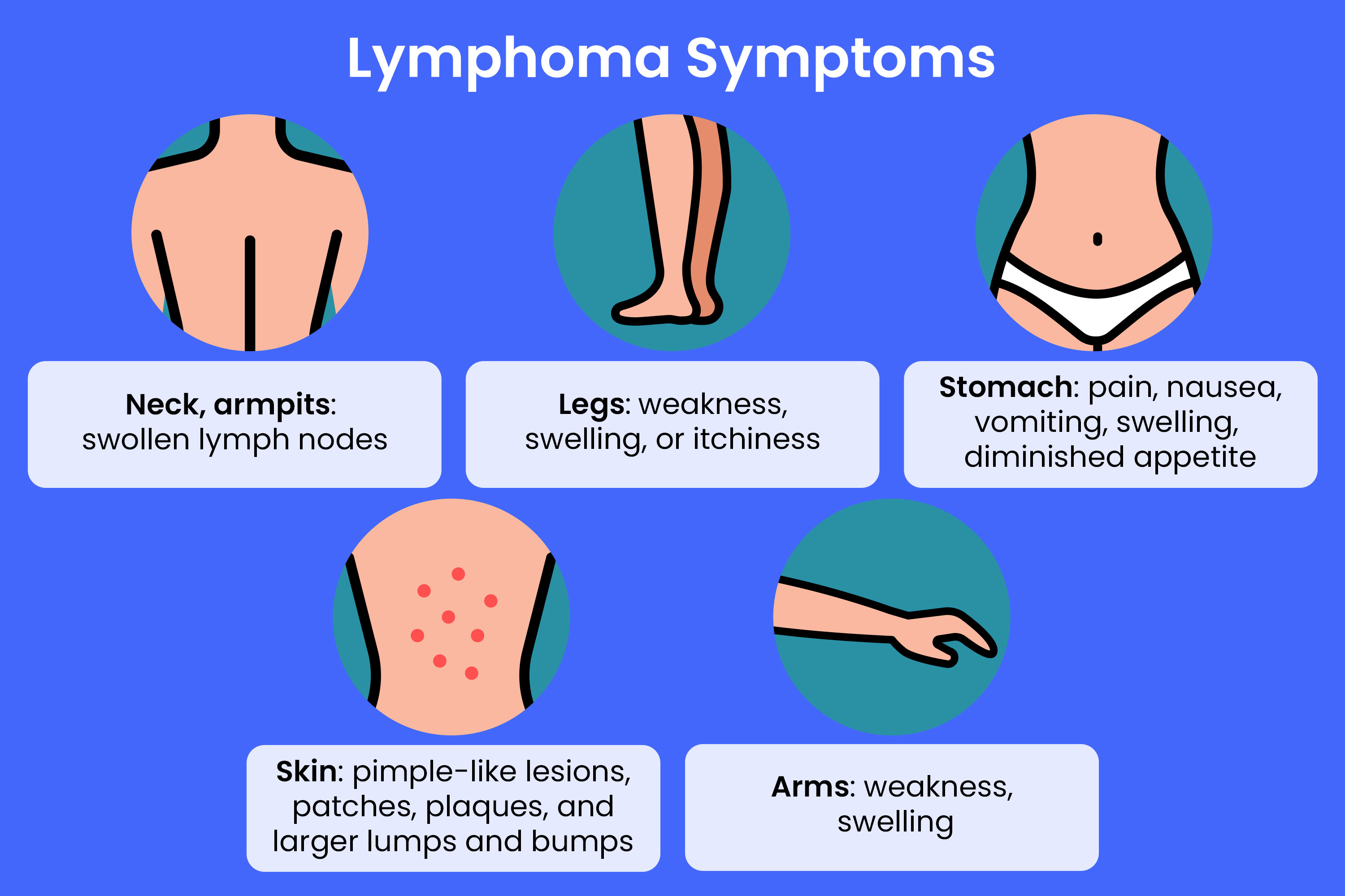 Abdominal Lymphoma Symptoms: What to Watch For