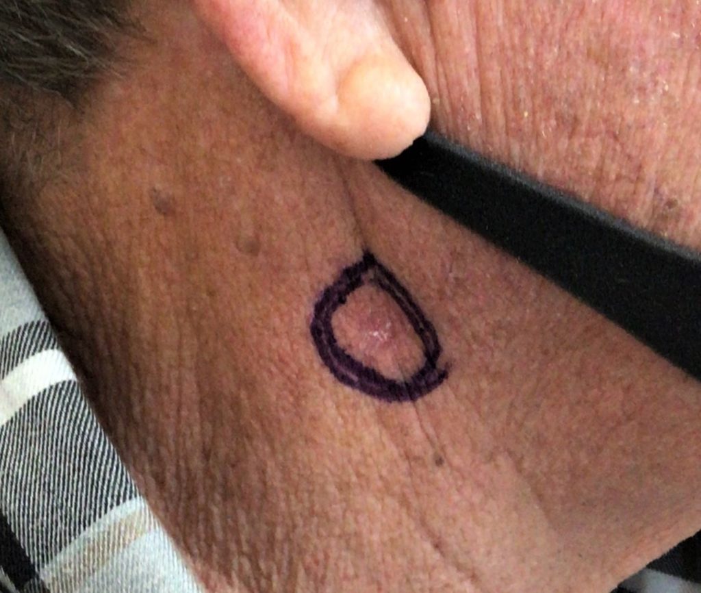 Early Skin Cancer Neck: Signs, Risks & What to Do