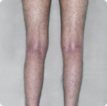 Rinvoq Eczema Before and After: Real Results & Tips