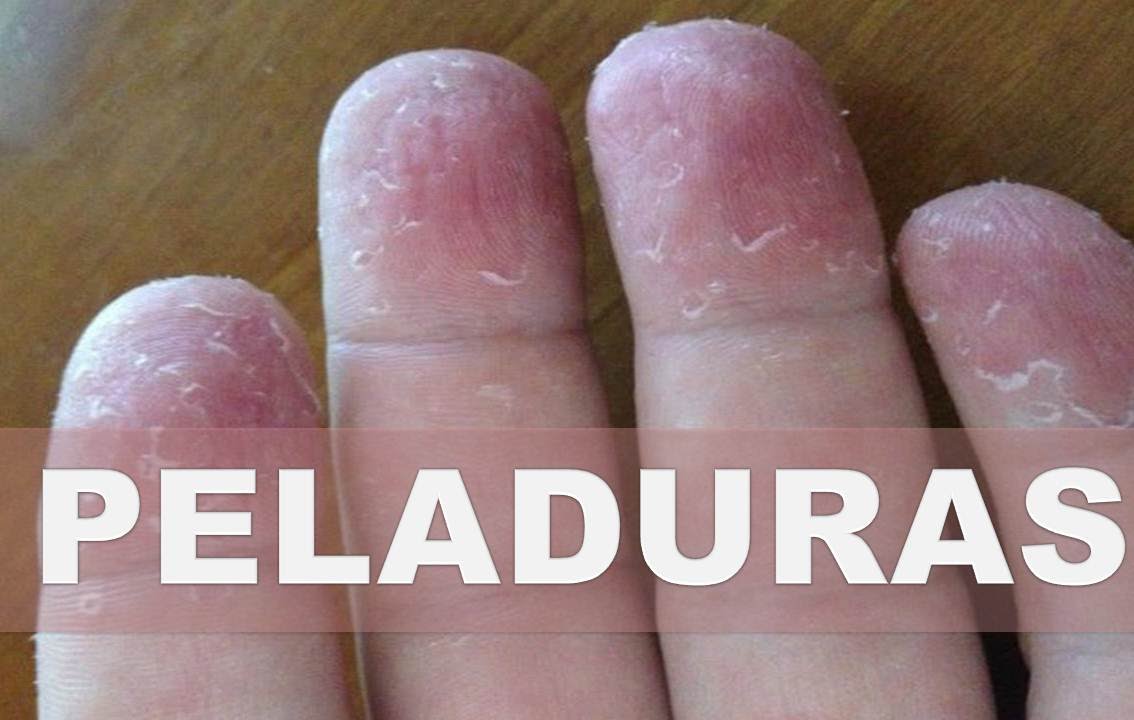 Porque Se Pelan Los Dedos De Las Manos En Niños