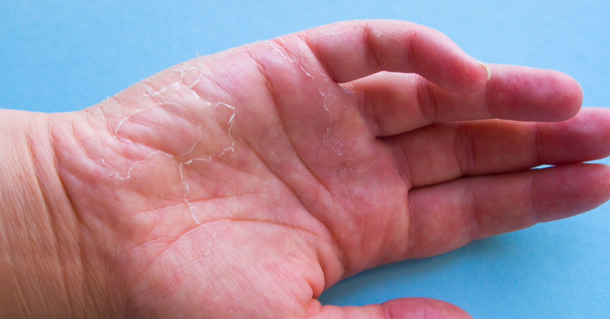 Se Pelan Las Manos Por Estrés