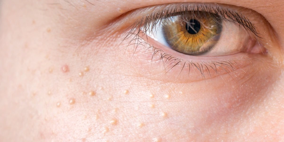 Puntos Blancos En La Piel