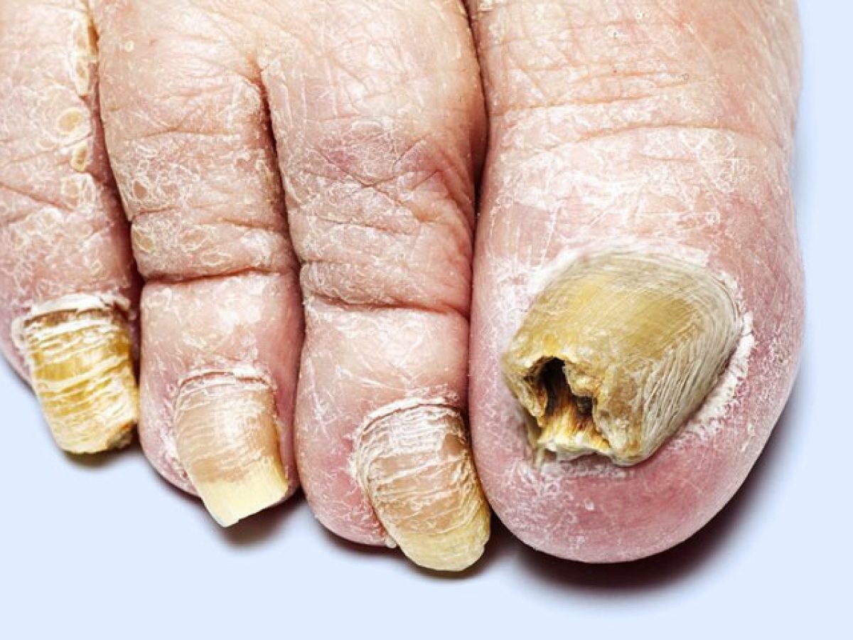 3 Tipos De Hongos En Las Uñas De Los Pies