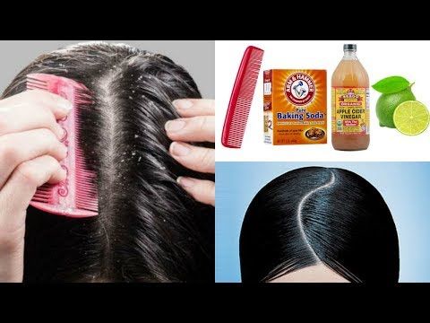 Como Quitar La Caspa En Un Día