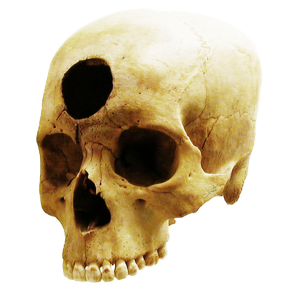 ¿qué Civilizaciones Antiguas Usaron La Técnica De Trepanación?