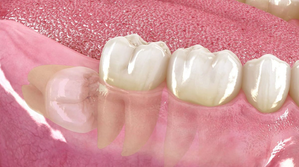 Que Pasa Si No Me Saco Las Muelas Del Juicio