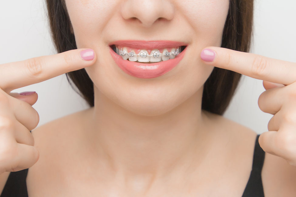 Brackets Precio Arequipa