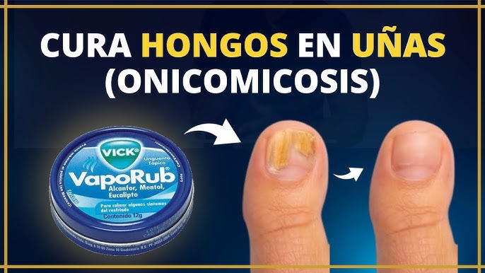 Como Curar Los Hongos De Las Uñas Rápidamente