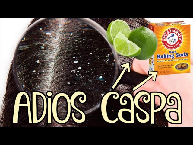 Como Eliminar La Caspa Para Siempre