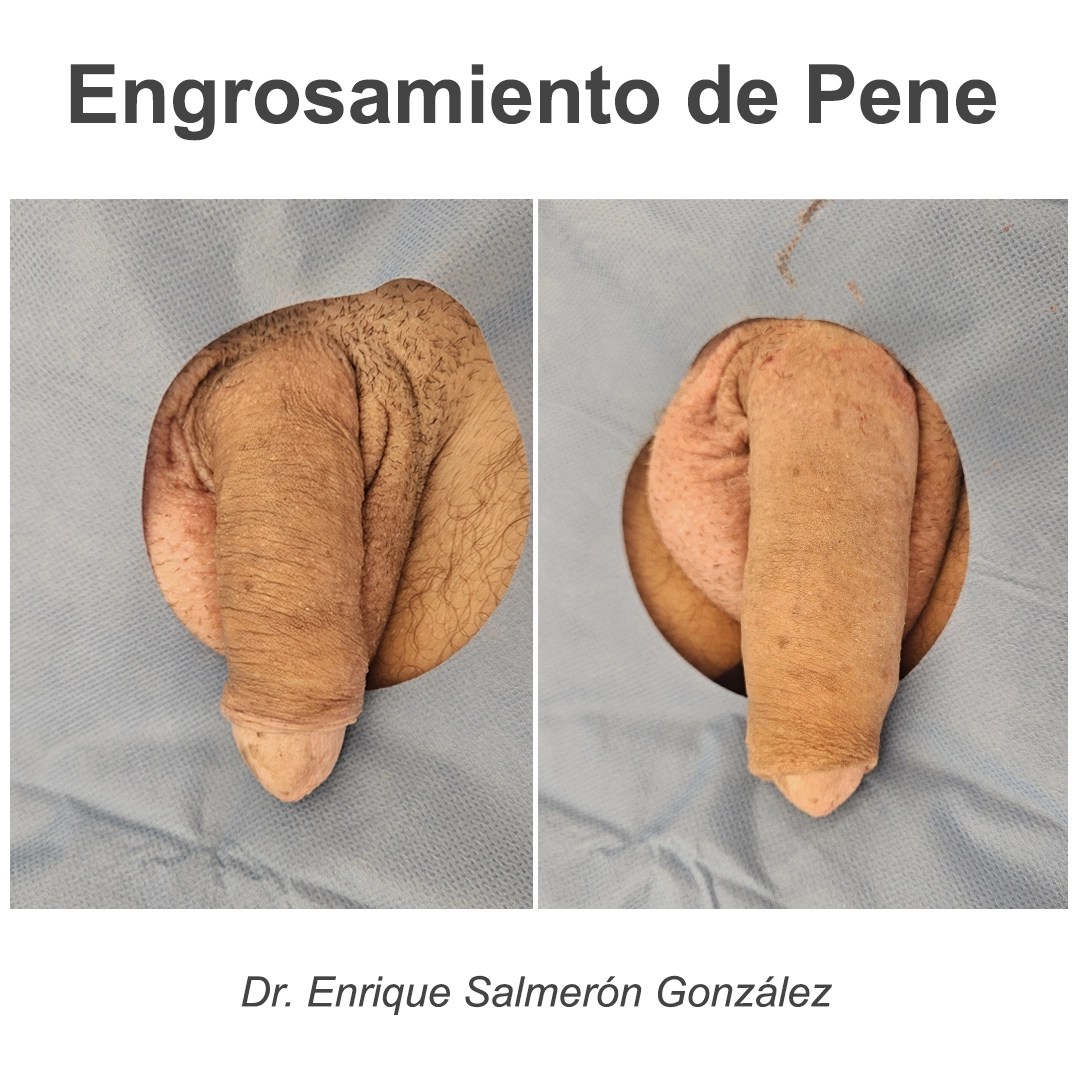Engrosamiento De Pene Permanente