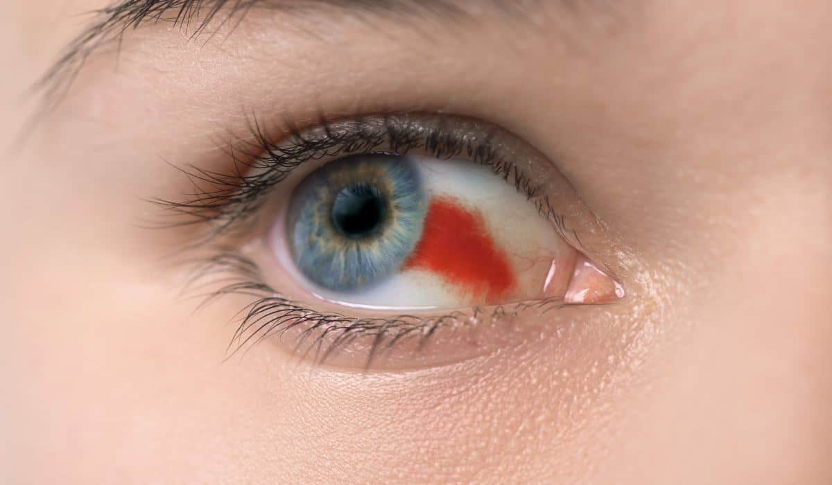 Mancha Roja En El Ojo Por Estrés