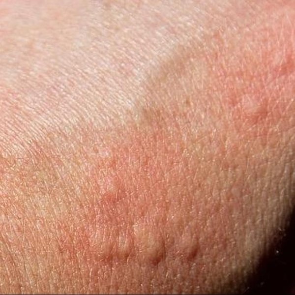 Tipos De Ronchas En La Piel Fotos