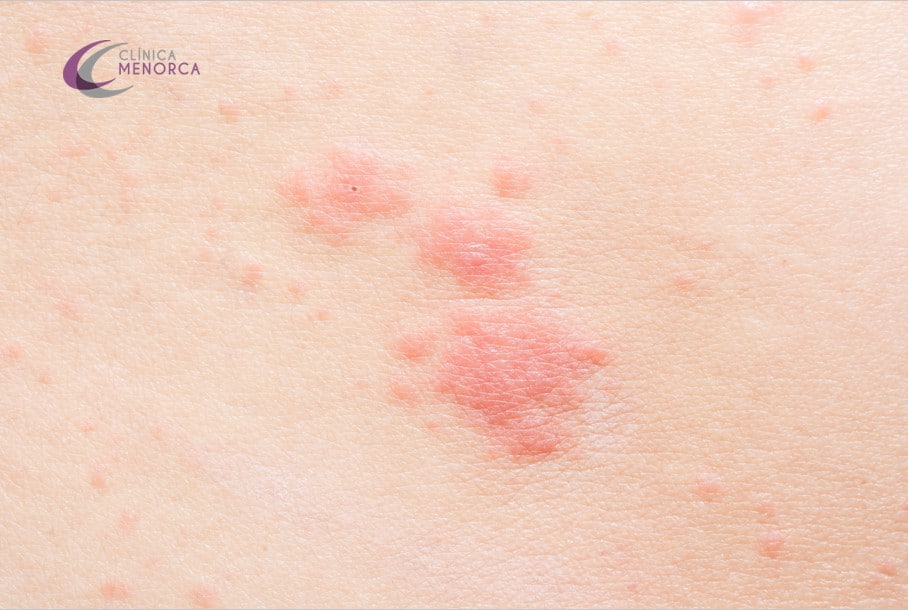 Tipos De Sarpullido